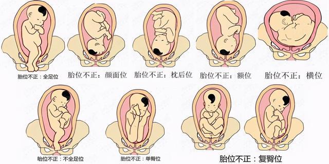 寶寶胎位不正你會看嗎？