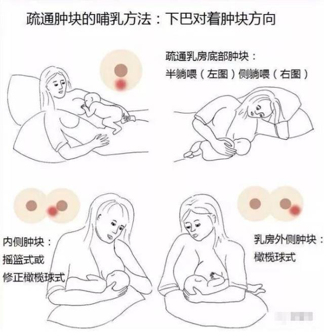 產(chǎn)后漲奶，疼痛難忍怎么辦？