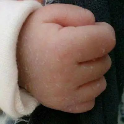 新生兒脫皮是正常的嗎？