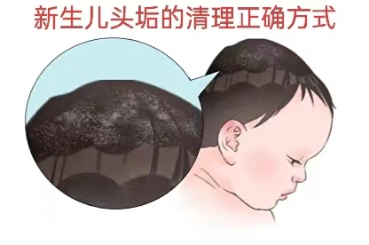 新生兒頭垢的正確清理方式